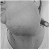 Красноярке удалили 1,5-килограммовую опухоль на лице. Она прожила с ней почти 12 лет