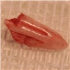 Из пальца красноярки удалили кошачий зуб: она проходила с ним несколько месяцев