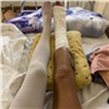 Красноярка упала с мотобайка на отдыхе в Таиланде и вернулась домой с 12 переломами